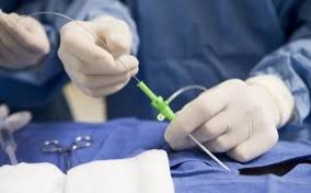 đốt viêm lộ tuyến