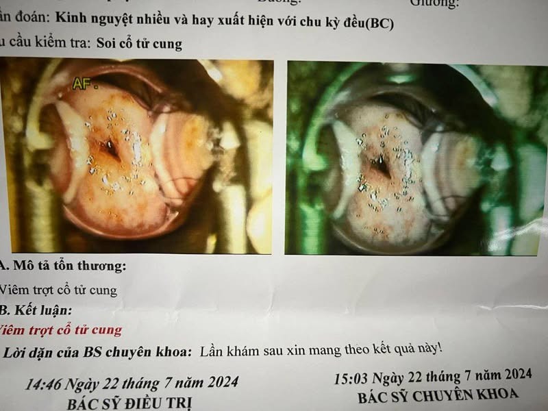 Viêm cổ tử cung kèm ra máu âm đạo giữa kỳ kinh thì nên điều trị gì? 2 67ef6234b0405 viem co tu cung