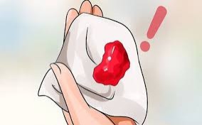 chảy máu âm đạo bất thường