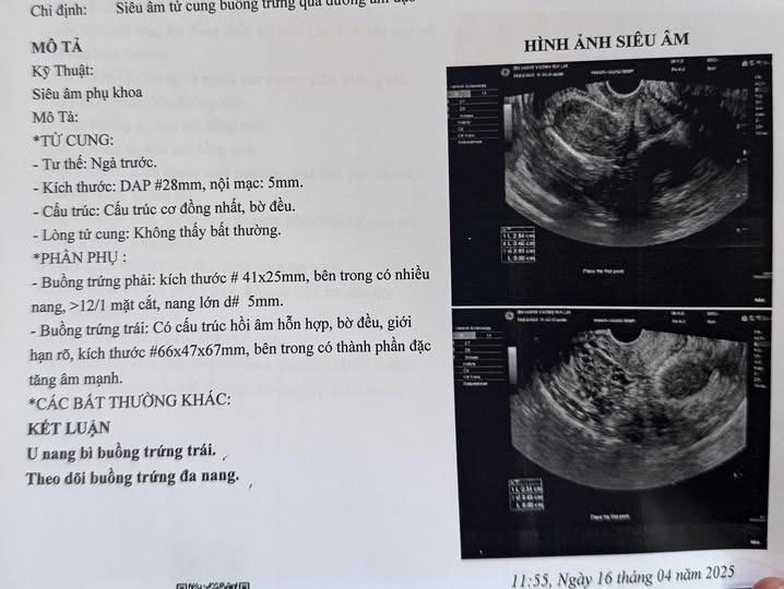 Kinh nguyệt hiện tại đã không có 4 tháng, bị nang buồng trứng giờ nên làm gì? 2 6812482cbfe81 nang buong trung