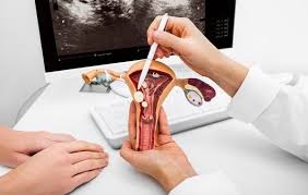 viêm lộ tuyến độ 3
