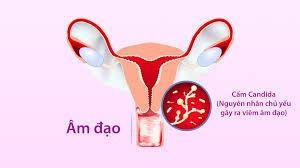 nấm âm đạo tái phát