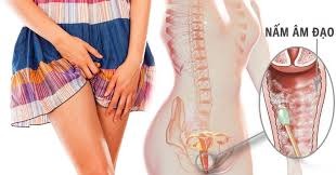 điều trị nấm vùng kín
