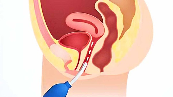thụt rửa sâu âm đạo