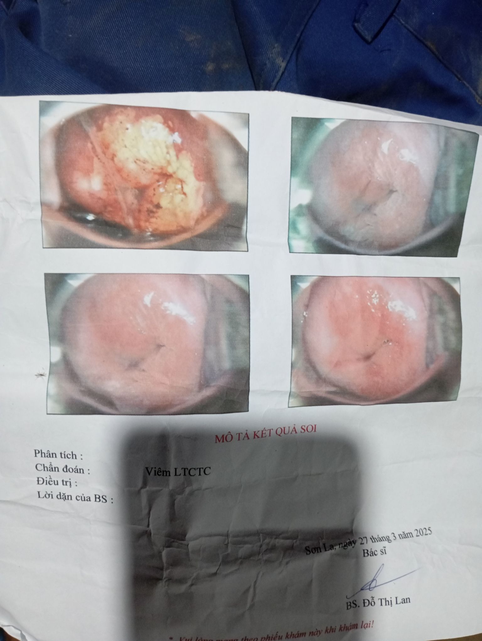 Viêm lộ tuyến cổ tử cung và phương pháp điều trị 2 685523b9723d6 viem lo tuyen co tu cung