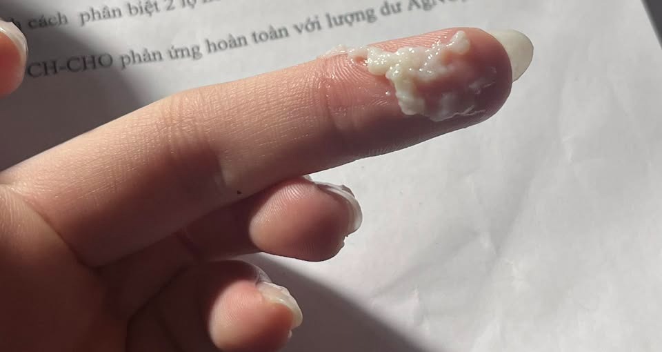 Khí hư đặc như bã đậu, không mùi nhưng hơi ngứa nhẹ có phải nhiễm nấm Candida không? 2 685dff7b3be9c khi hu
