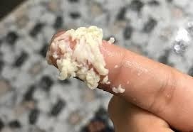 khí hư bám đầy
