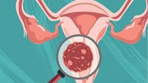 viêm lộ tuyến độ 2