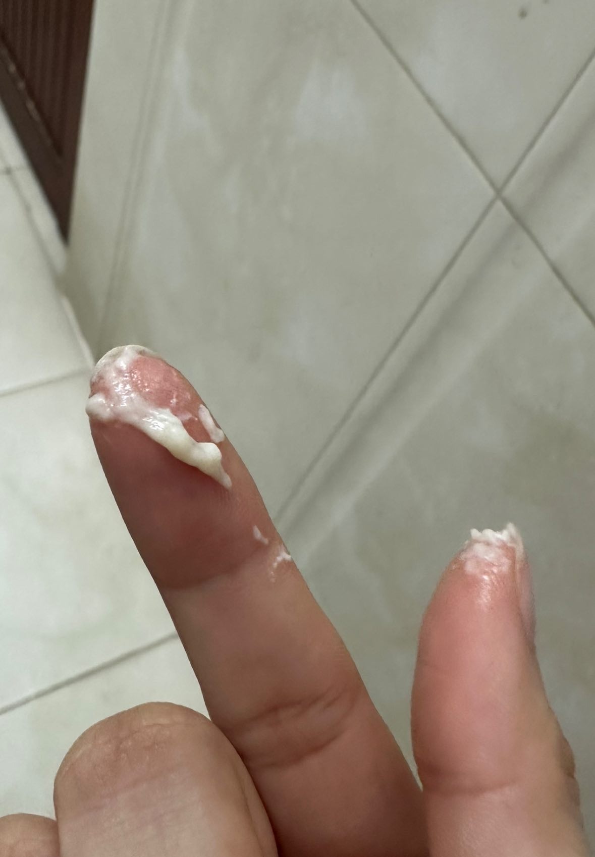 Khí hư trắng đặc như bã đậu là bị gì? 2 68d5ed2e941a5 khi hu