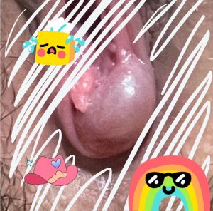 Điều trị u nang tuyến Bartholin như thế nào? 2 Hình ảnh do khách hàng ẩn danh cung cấp