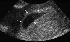 ứ dịch cổ tử cung