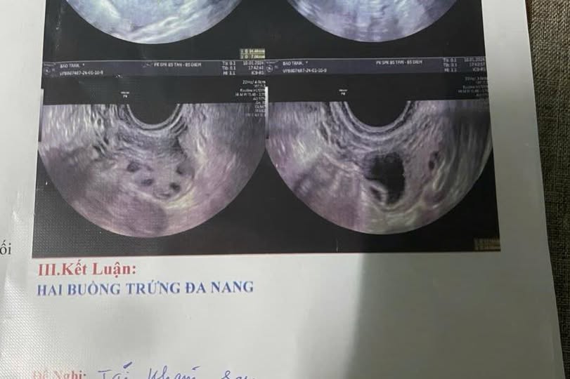 Đa nang và u nang buồng trứng khác nhau thế nào? 2 530808622 723075134117731 1715634122319184307 n