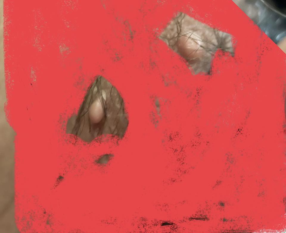 Vùng kín nổi nốt mụn tròn không đau, không ngứa có sao không? 2 559310272 835179735530123 2960299696150272634 n