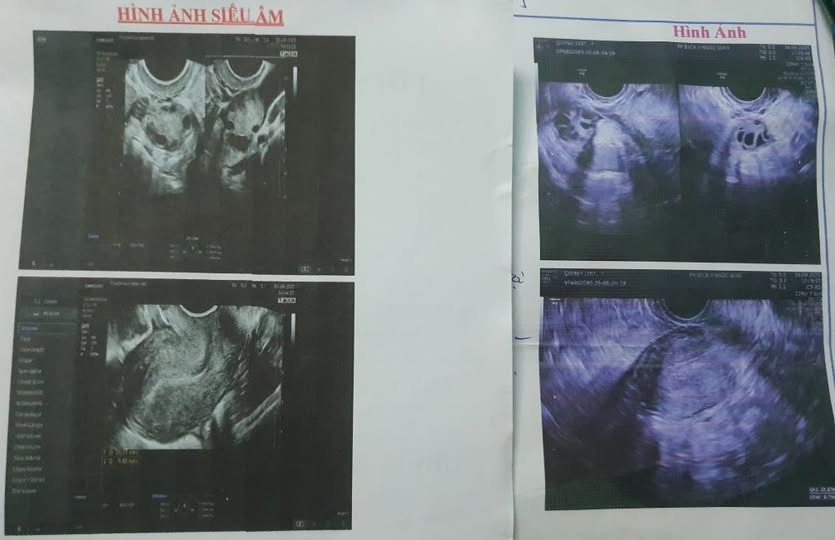 Đa nang buồng trứng (PCOS) có phải chỉ cần nhìn siêu âm là chẩn đoán được không? 2 691a975b535ac buong trung da nang