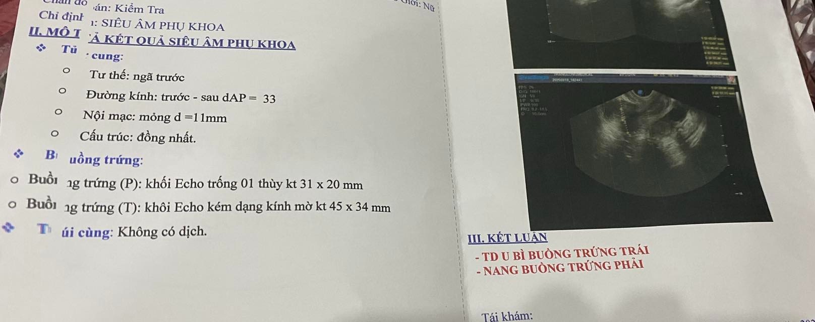 Nang buồng trứng là gì? Có nguy hiểm không? 2 69343c98902ac lac noi mac tu cung 1