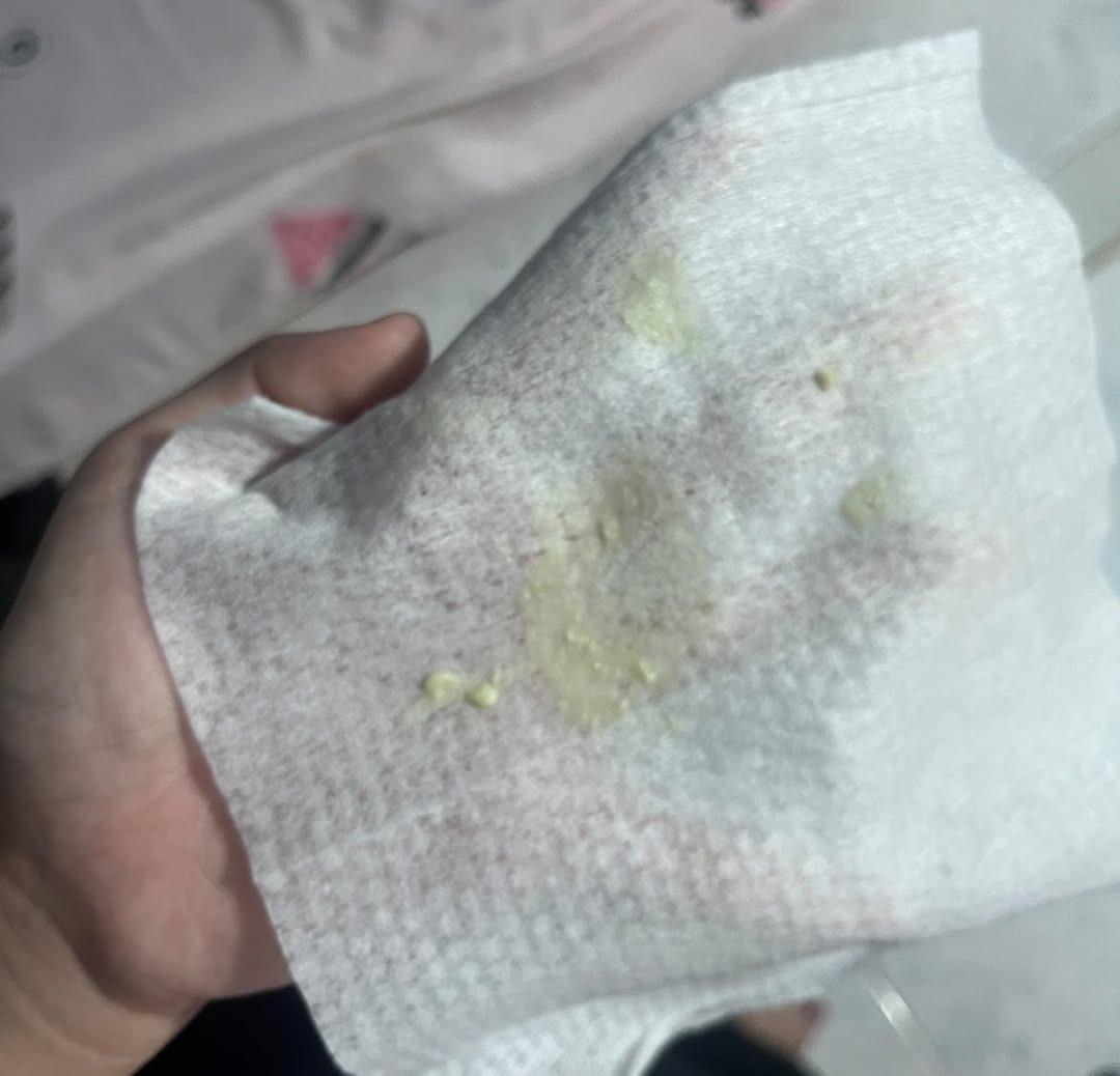 Khí hư vàng vón cục có phải bị viêm không? 2 6940b72e99c01 viem phu khoa