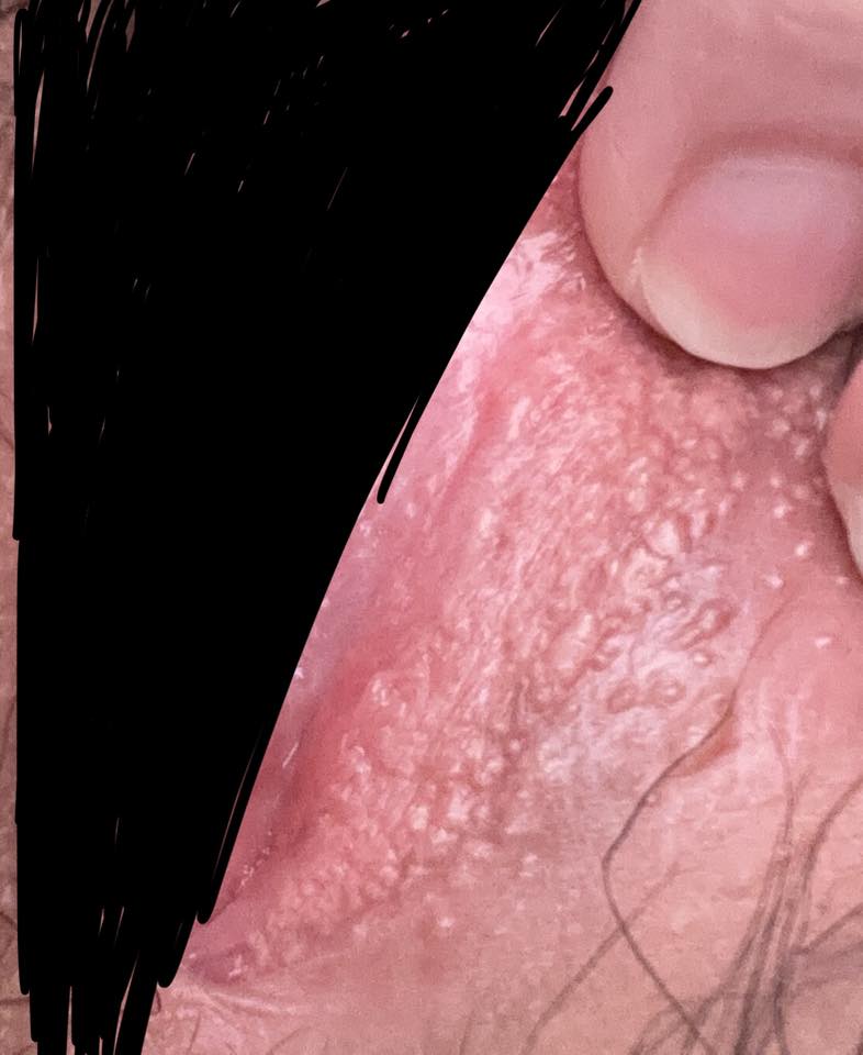 Phân biệt sùi mào gà và gai sinh dục thế nào? 2 652951593 26192091117112413 2734858879052131161 n