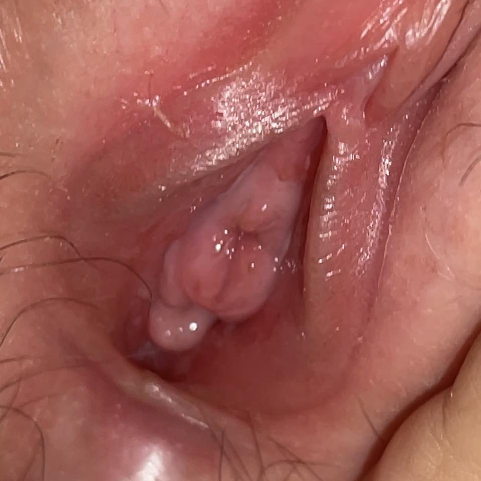 Ngứa vùng kín, ra dịch nâu đỏ có phải bị viêm lộ tuyến không? 2 672684917 1258262056449767 7060870358020171902 n