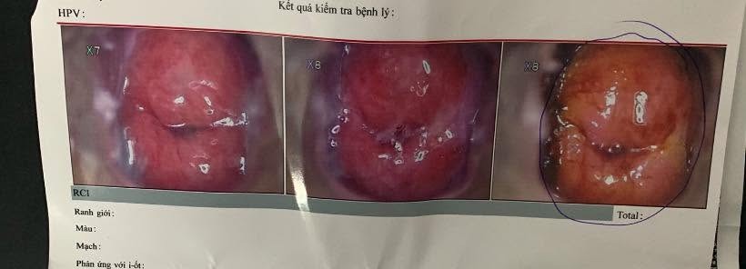Soi cổ tử cung thấy bất thường có phải bệnh nặng không? 2 6a26270974b6d soi co tu cung thay bat t
